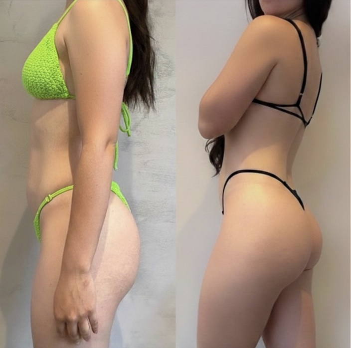 Client side-profile before and after