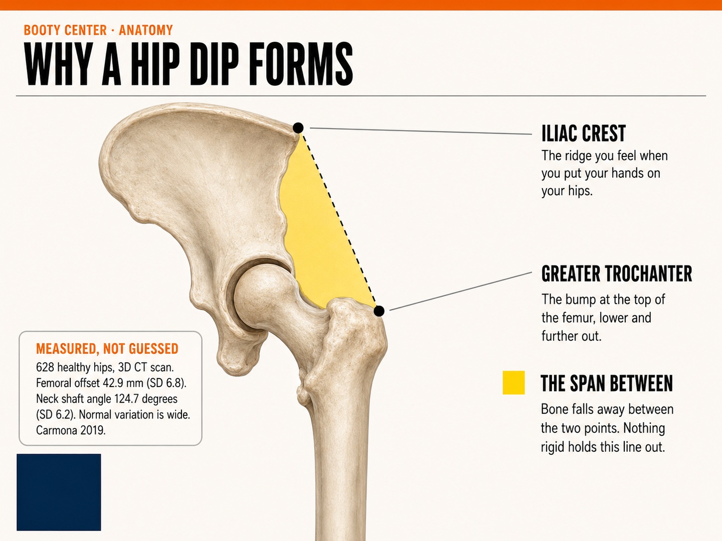 Why a hip dip forms: the gap between the iliac crest and the greater trochanter of the femur