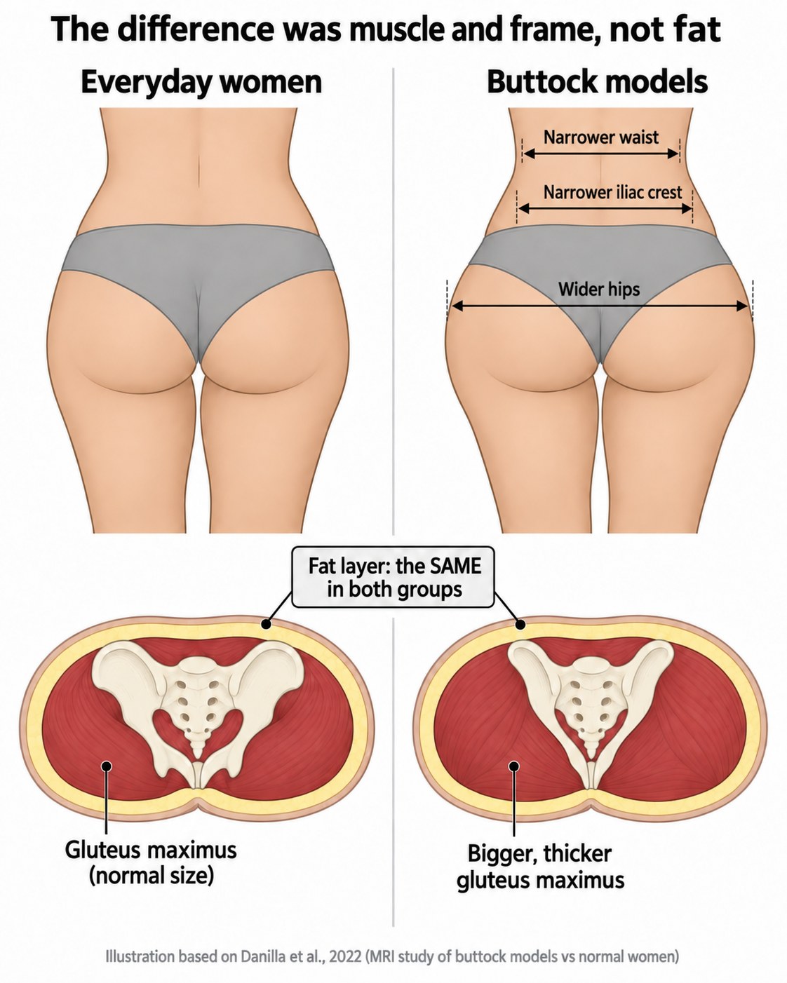Comparison diagram showing buttock models and everyday women have the same subcutaneous fat thickness, but models have a larger gluteus maximus, narrower waist, narrower iliac crest and wider hips.
