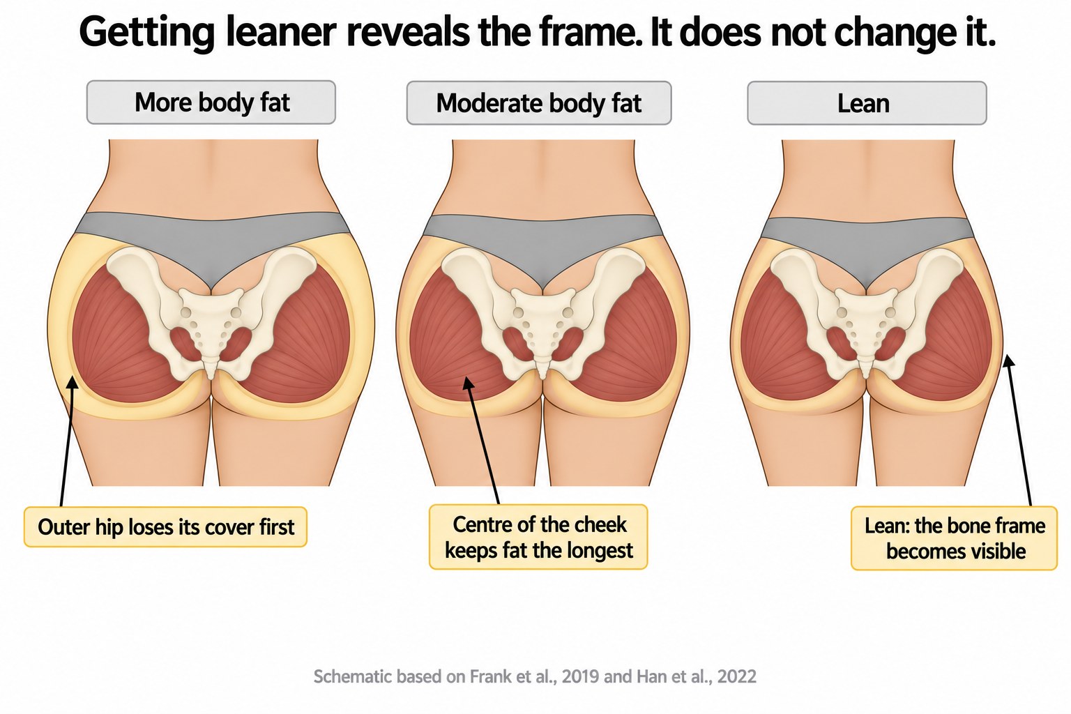 Three-panel sequence showing the same hips at high, moderate and low body fat, with the outer hip losing fat cover first and the centre of the buttock keeping fat longest.