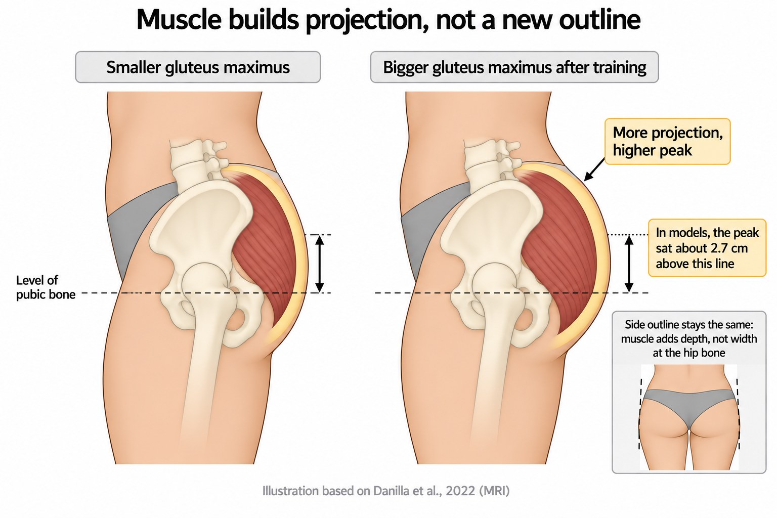 Side view comparison showing a larger gluteus maximus increases backward projection and raises the peak, while the width at the hip bone stays unchanged.